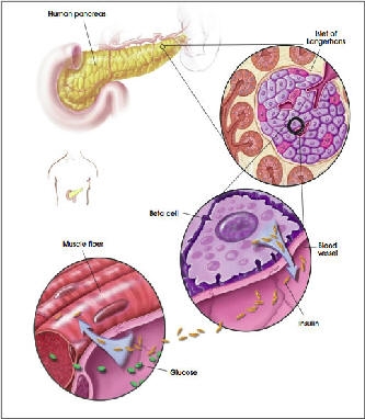 Diabet - remediu terapeutic