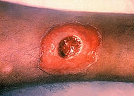 Difterie - complicatii si tratament