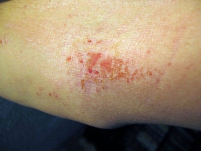 imagini eczeme