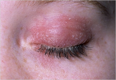 images eczeme