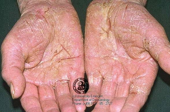 imagine cu eczemele