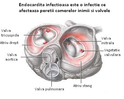 Edocardita lenta