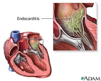 imagini edocardita