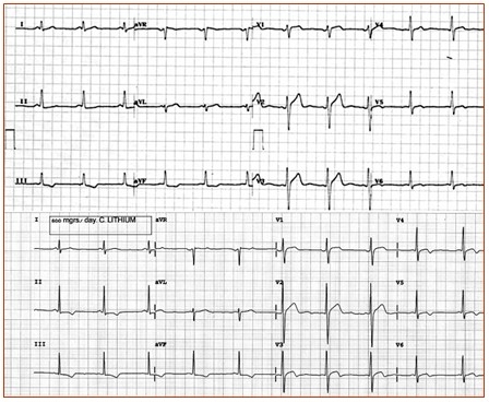 Hipertrofiile la electrocardiograma patologica