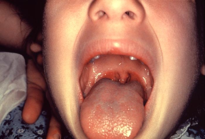 poza despre faringita