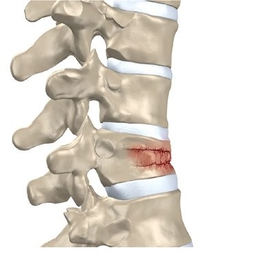 Diagnosticul unei fracturi