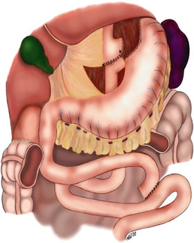 Ceai gastric