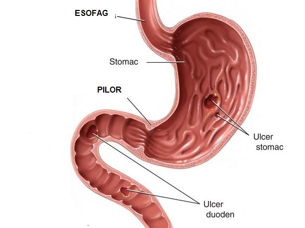 Gastrita bontului gastric restant (stomita, gastrita alcalina postoperatorie de reflux)