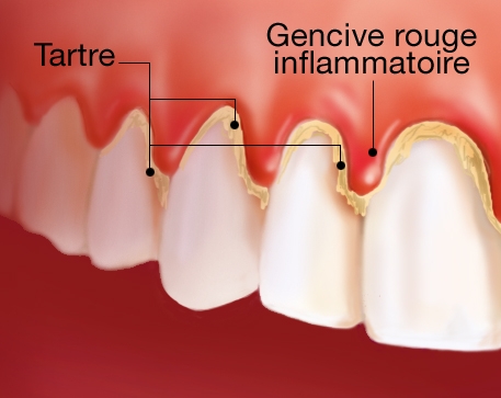 imagini gingivitele