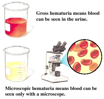 Hematuria la copil