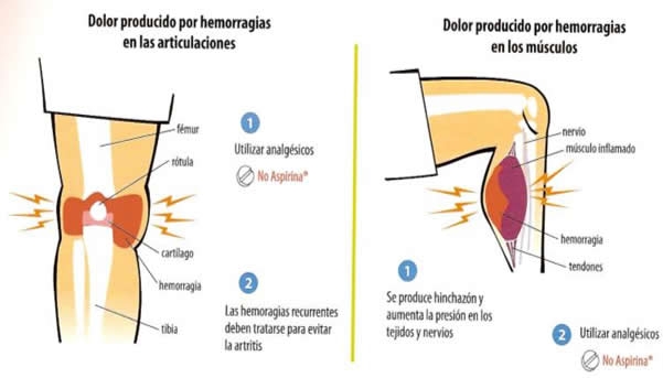 Hemofilia a