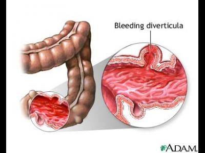 Hemoragia digestiva superioara