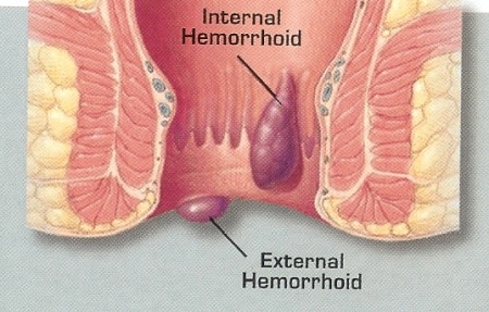 imagine cu hemoroizii