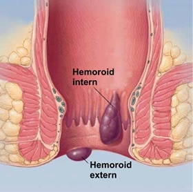 Hemoroizii - cum scap de hemoroizi?