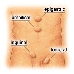 Hernia inghinala