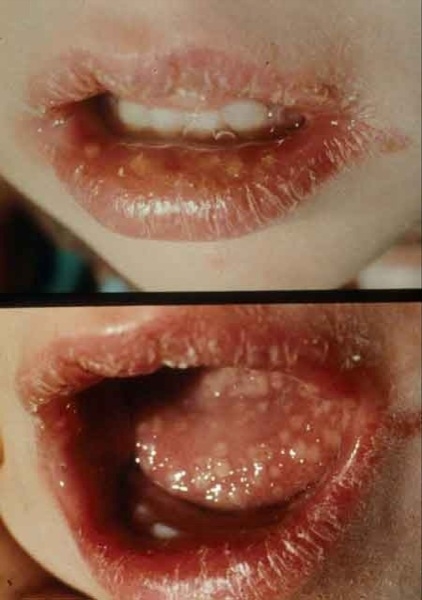 Herpes simplex