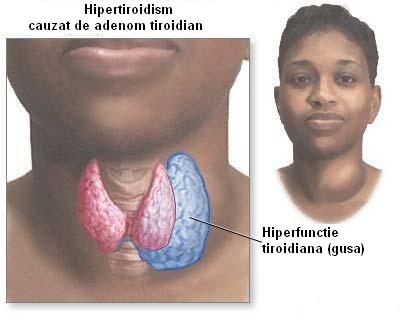 Hipertiroidismul si adenomul toxic tiroidian - tratament cu argila