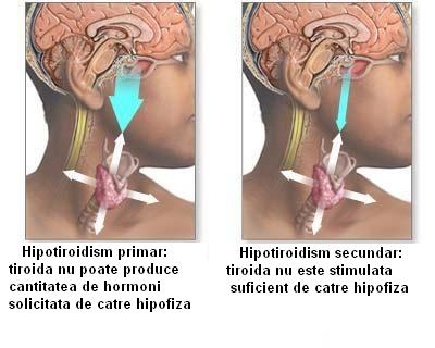 imagini hipotiroidismul