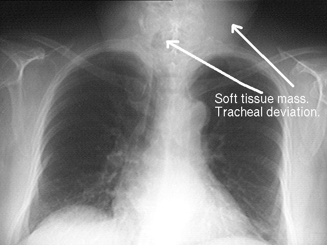 Hodgkin disease