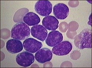 Leucemia cu plasmocite