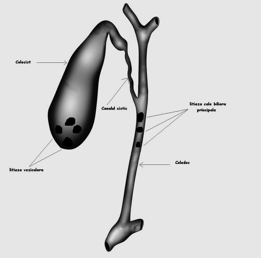Litiaza caii biliare principale