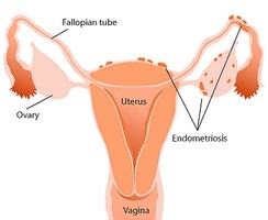 Menstruatie