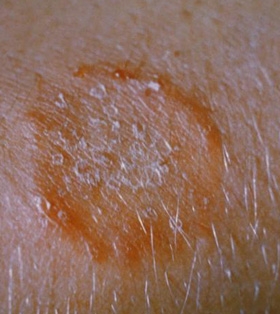 micoze a pielii tratamente