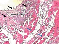 Miocarditele si cardiomiopatiile