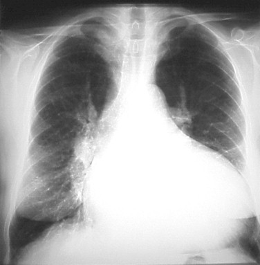 Unele miocardopatii metabolice