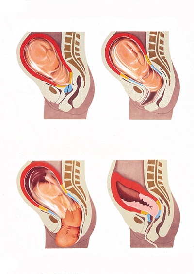 Pregatirea fitoterapeutica pentru nastere