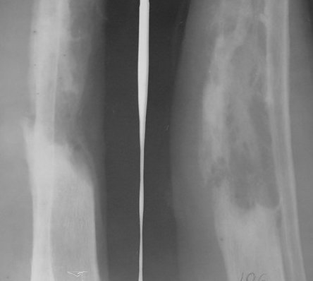 Osteomielita - clasificare - cai de patrundere