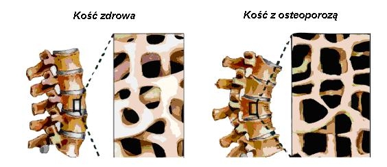 Osteoporoza (oase casante) la mnopaza?