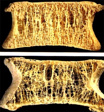 Afectiunile metabolice osoase - osteoporoza