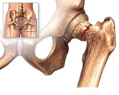 poza despre osteoporoza