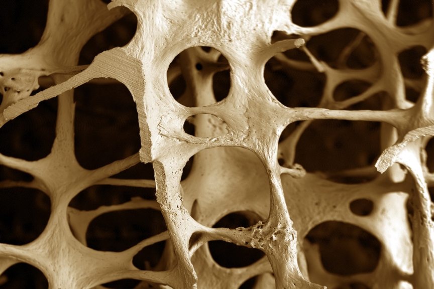 Aspecte de geropatologie a aparatului locomotor - osteoporoza