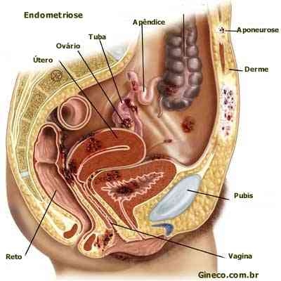 Ovare polichistice