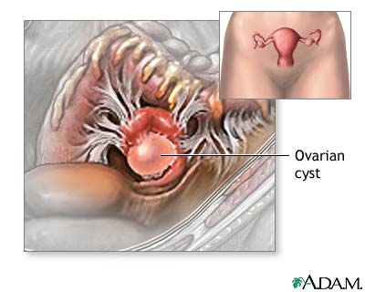 imagini ovarian