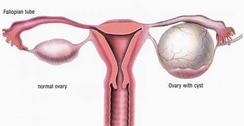 Chistul ovarian functional