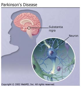 Parkinson syndrome (paralysis agitans; shaking palsy)