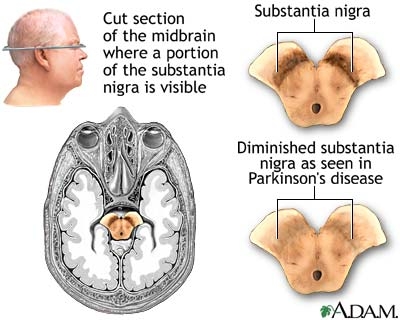 imaginile despre parkinson