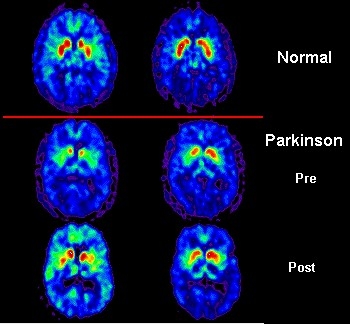 imagini parkinsonul