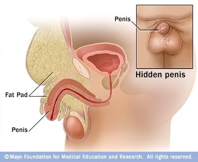 Induratie penis plastica