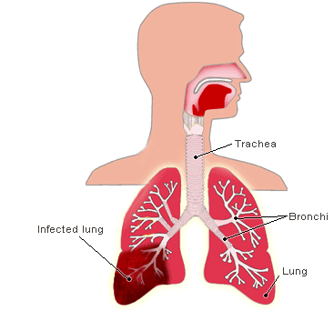 imagine cu pneumonia