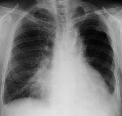 imagini pneumonia