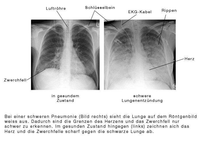 imagini pneumonie