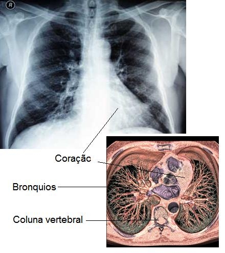 imagine cu pneumopatia