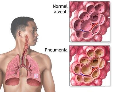 Pneumopatiile bacteriene