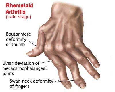 tratamentul inflamației articulației pe picior durere în articulațiile membrelor mâinilor și picioarelor