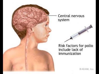 Poliomielita (paralizie infatila)