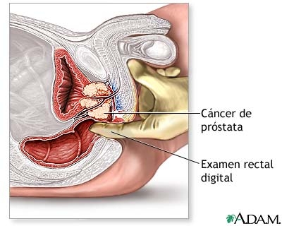 Probleme de prostata